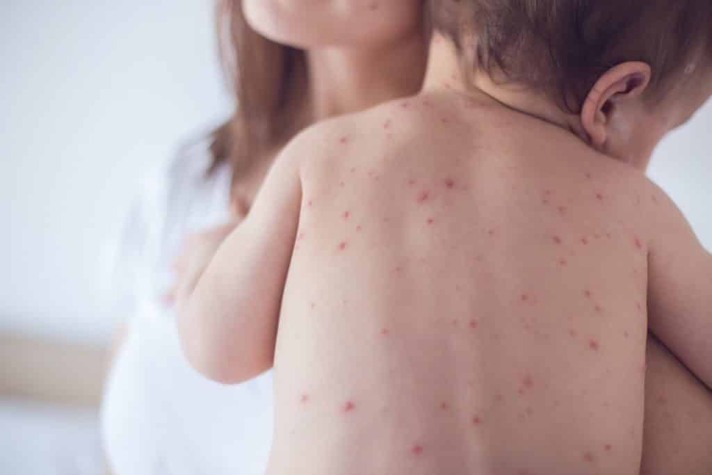 Mother taking care of baby with chicken pox