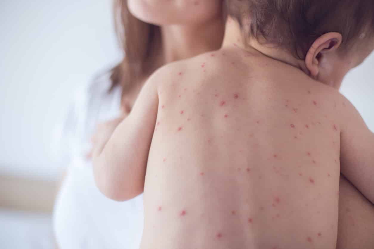 What Age To Get Measles Vaccine?