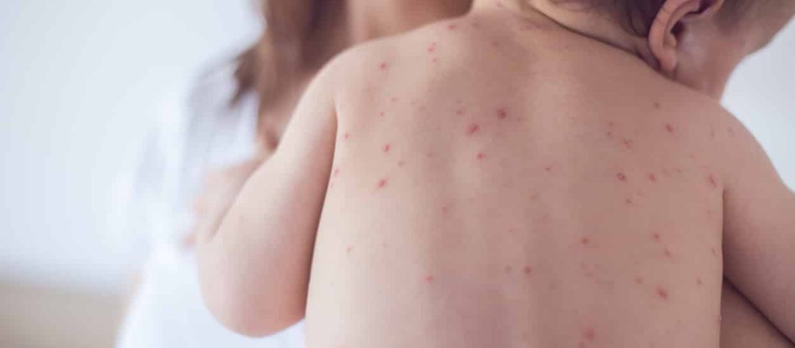 Mother taking care of baby with chicken pox